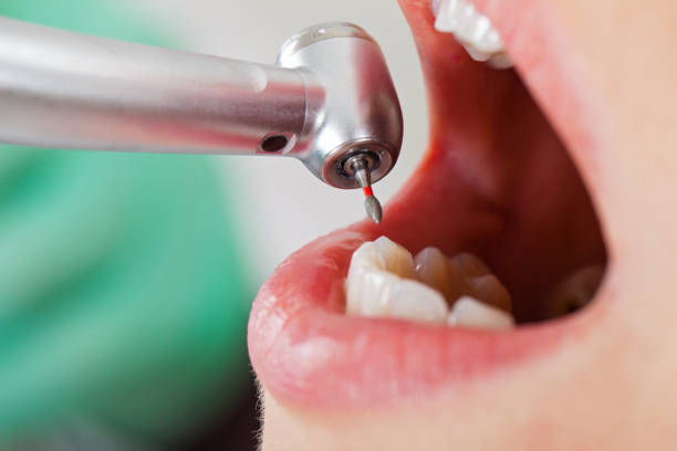 Best Emergency Wisdom Teeth Removal in Cambridge, WI